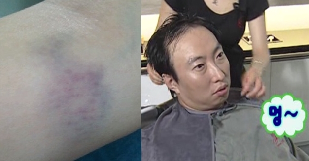 '멍'이 자주 들고 잘 빠지지 않을 때는 당장 병원으로 직행해야한다